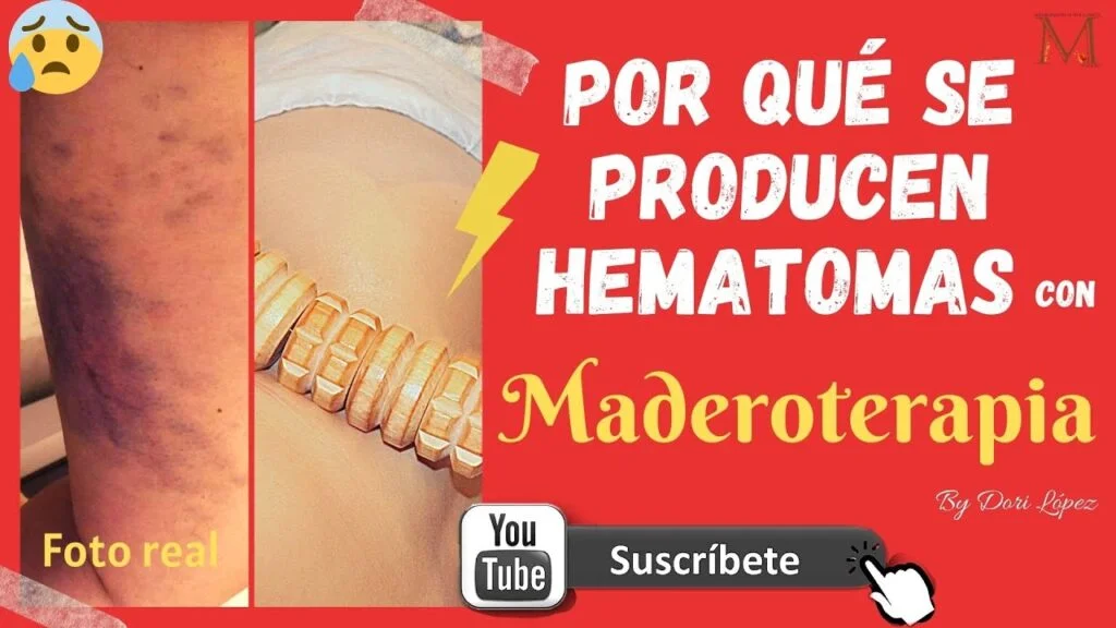 Descubre la verdad detrás de los moretones después de un masaje anticelulítico: Todo lo que necesitas saber 1 ¿Es normal que salgan moretones despues de un masaje anticelulitico